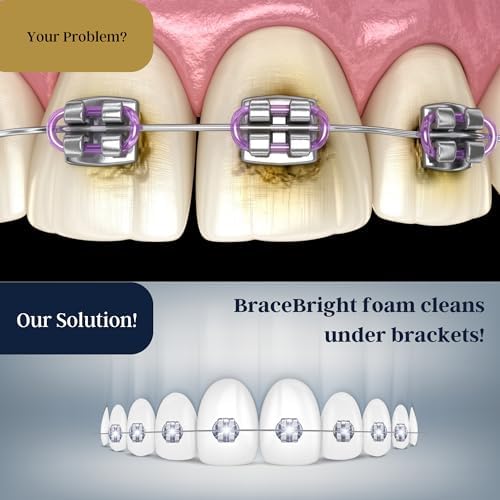 Teeth Whitening for Braces, Braces Cleaner Foam, Brace Teeth Whitening kit for Under Metal, Ceramic, Brackets & Wires. Cleaning Kit, Use w/Toothbrush or Trays No Sensitivity. Minty, Teens, Adults