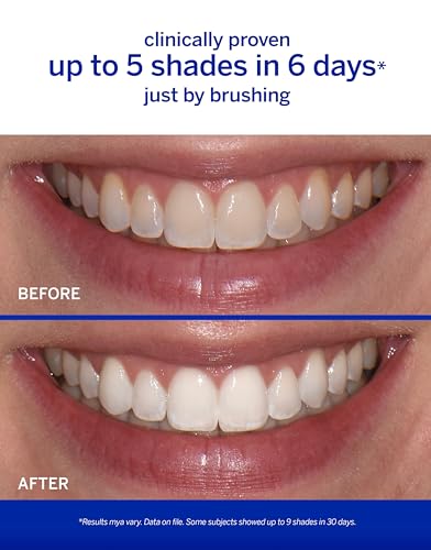Supersmile The Works – whitening toothpaste and accelerator in one easy-to-use formula – Whitens Up to 6 Shades, Sassy Mint, 7 oz