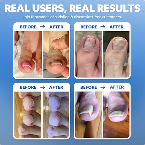 CurveCorrect® Ingrown Toenail Treatment Kit - Ingrown Toenail Corrector Kit with 10 Braces - at Home Ingrown Toenail Correction - Big Toe Ingrown Nail Treatment