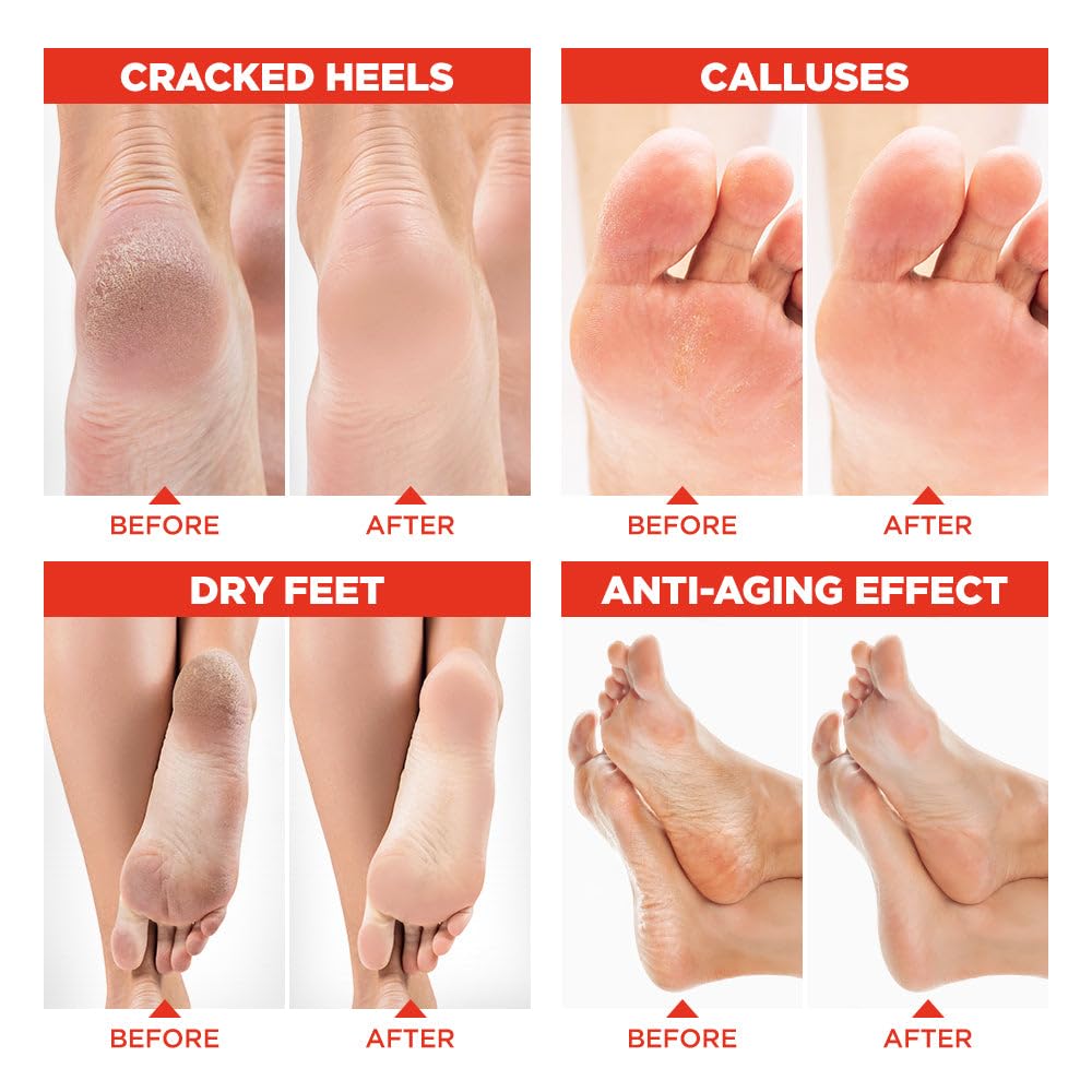 Lavinso Peach Foot Peel Mask for Dry Cracked Feet - 3 Pack - Dead Skin Remover Foot Mask for Cracked Feet and Callus - Exfoliating Feet Peeling Mask for Soft Baby Feet